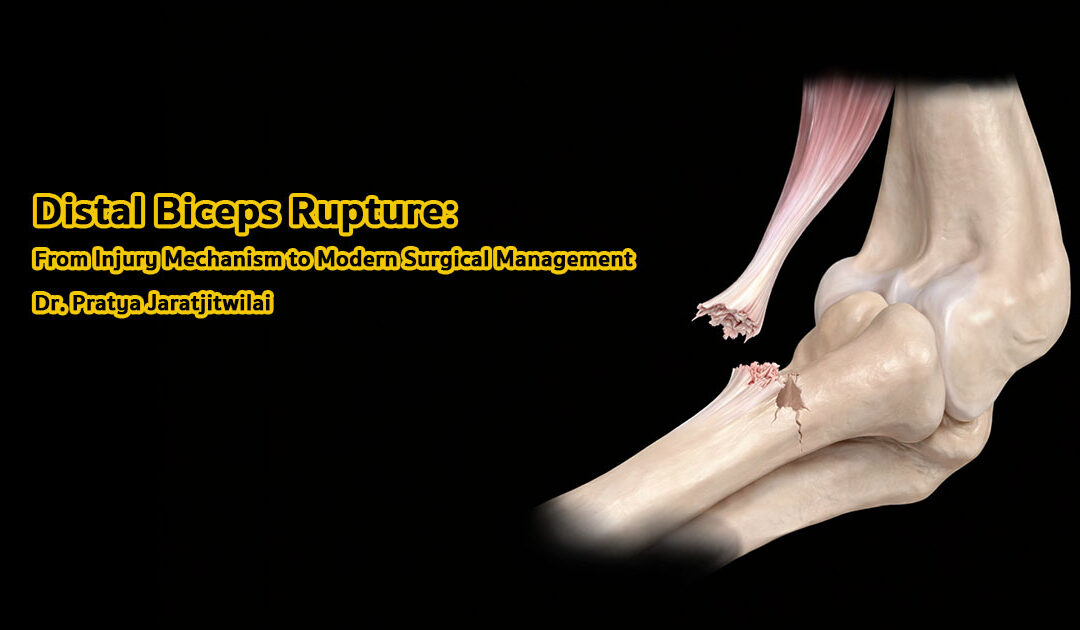 Distal Biceps Rupture: กลไกการบาดเจ็บและเทคนิคการผ่าตัดสมัยใหม่ในการรักษาเอ็นกล้ามเนื้อไบเซปส์ส่วนปลายฉีกขาด