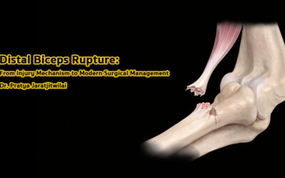 Distal Biceps Rupture: กลไกการบาดเจ็บและเทคนิคการผ่าตัดสมัยใหม่ในการรักษาเอ็นกล้ามเนื้อไบเซปส์ส่วนปลายฉีกขาด
